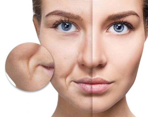 Cach Xoa Nep Nhan Hieu Qua Chuan Y Khoa – Bi Quyet Tre Hoa Da 3