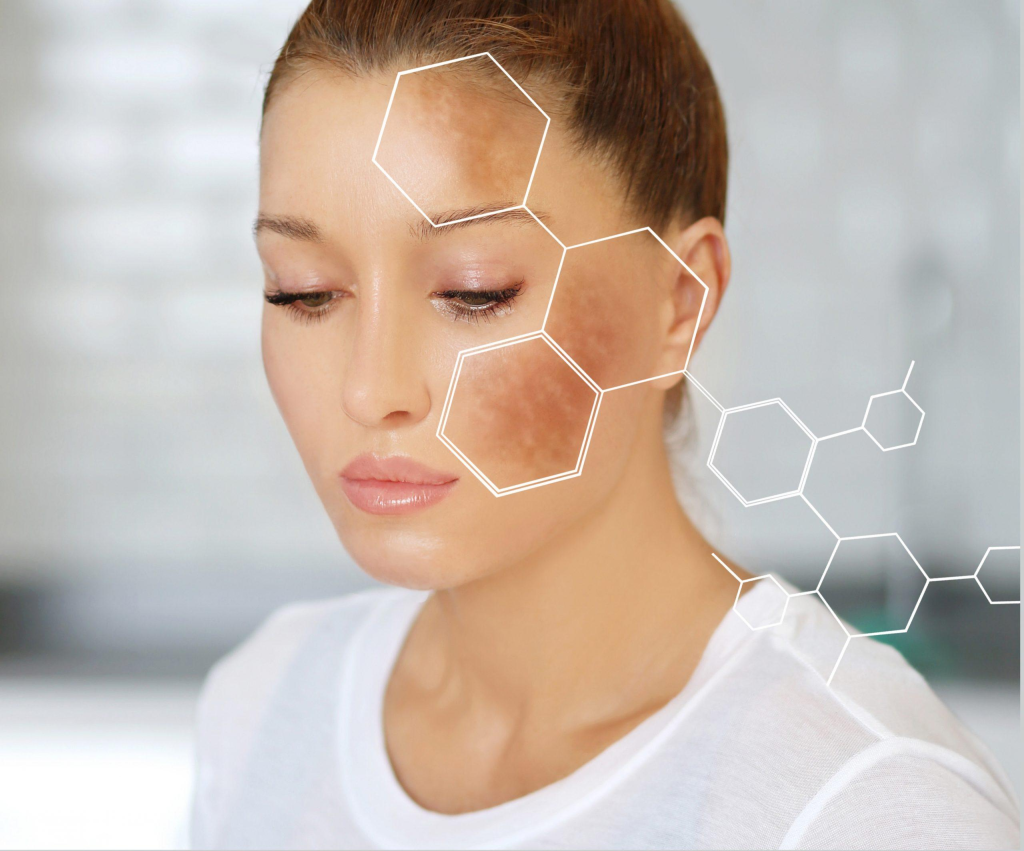 [Review] Trị Nám Obagi – Phương Pháp Không Dành Cho Người “Yếu Tim” (1)