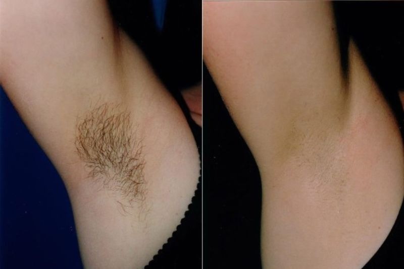 Tẩy Lông Nách Bị Rát Có Sao Không? 6 Cách Khắc Phục Hiệu Quả Từ LiA Spa & Beauty